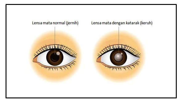 Detail Selaput Pelangi Pada Mata Nomer 30