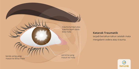 Detail Selaput Pelangi Pada Mata Nomer 36