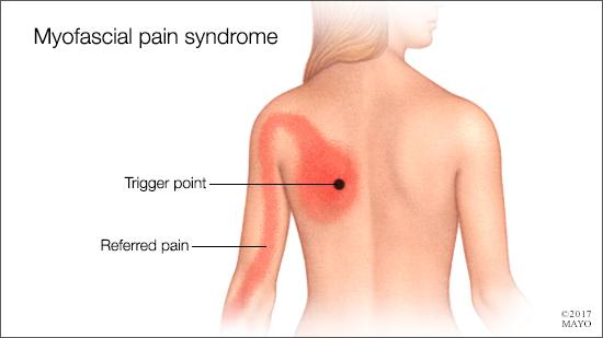 Sindrom Nyeri Myofascial - KibrisPDR