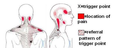 Detail Sindrom Nyeri Myofascial Nomer 16