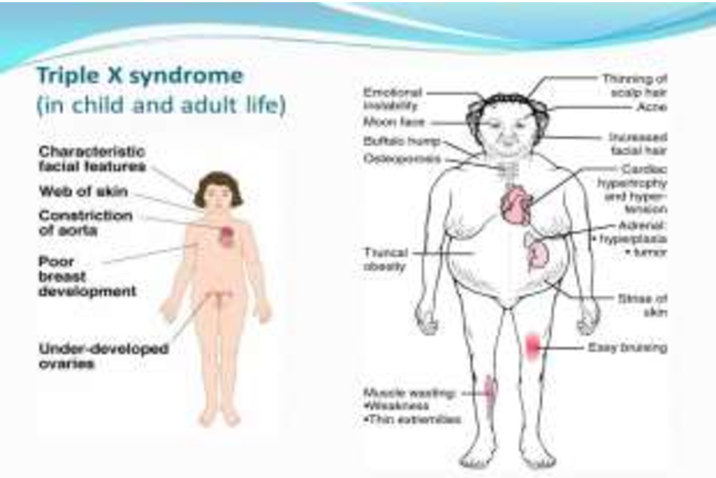 Detail Sindrom Triple X Nomer 10
