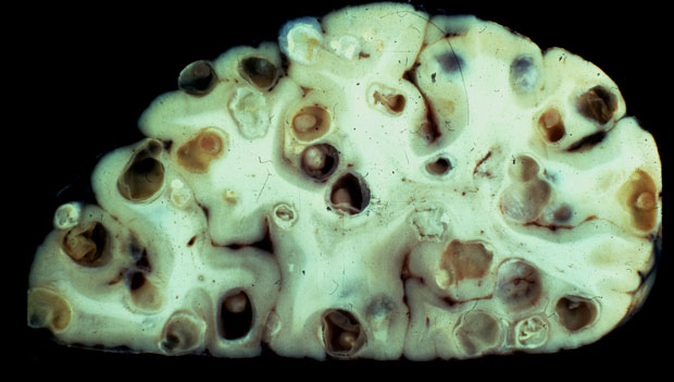 Detail Worms In Brain Due To Cabbage Nomer 11