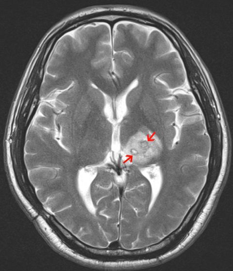 Detail Worms In Brain Due To Cabbage Nomer 16