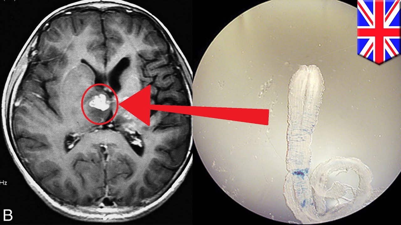 Detail Worms In Brain Due To Cabbage Nomer 17