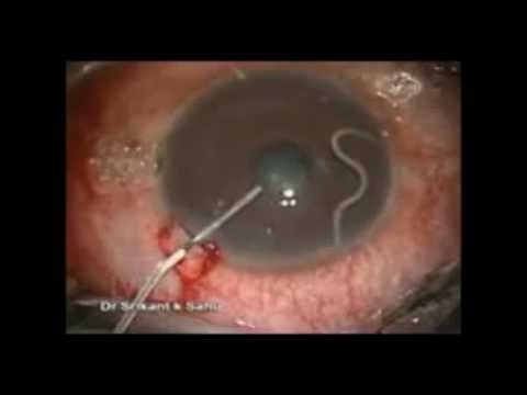 Detail Worms In Brain Due To Cabbage Nomer 33