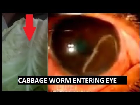 Detail Worms In Brain Due To Cabbage Nomer 35