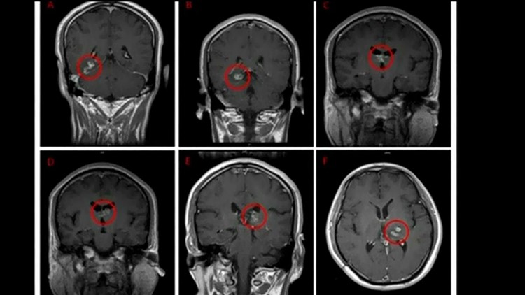 Detail Worms In Brain Due To Cabbage Nomer 37