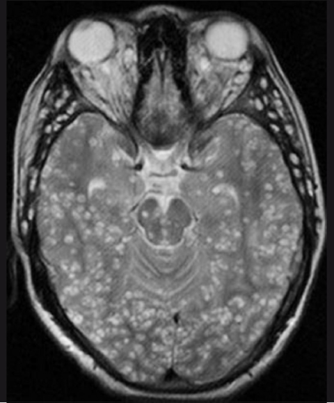 Detail Worms In Brain Due To Cabbage Nomer 38