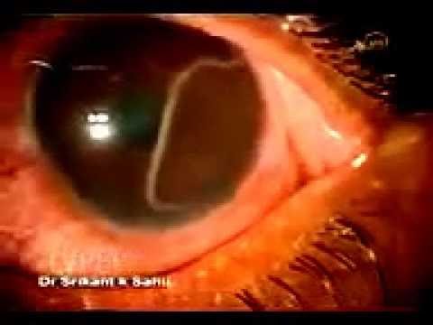Detail Worms In Brain Due To Cabbage Nomer 47