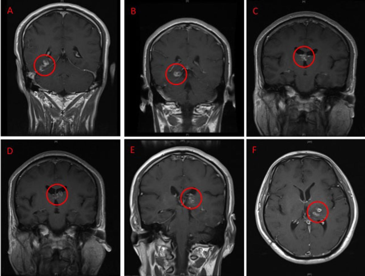 Detail Worms In Brain Due To Cabbage Nomer 48