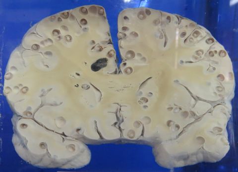 Detail Worms In Brain Due To Cabbage Nomer 57