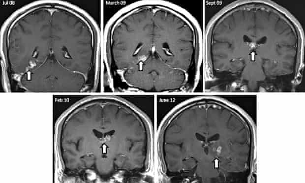 Detail Worms In Brain Due To Cabbage Nomer 8