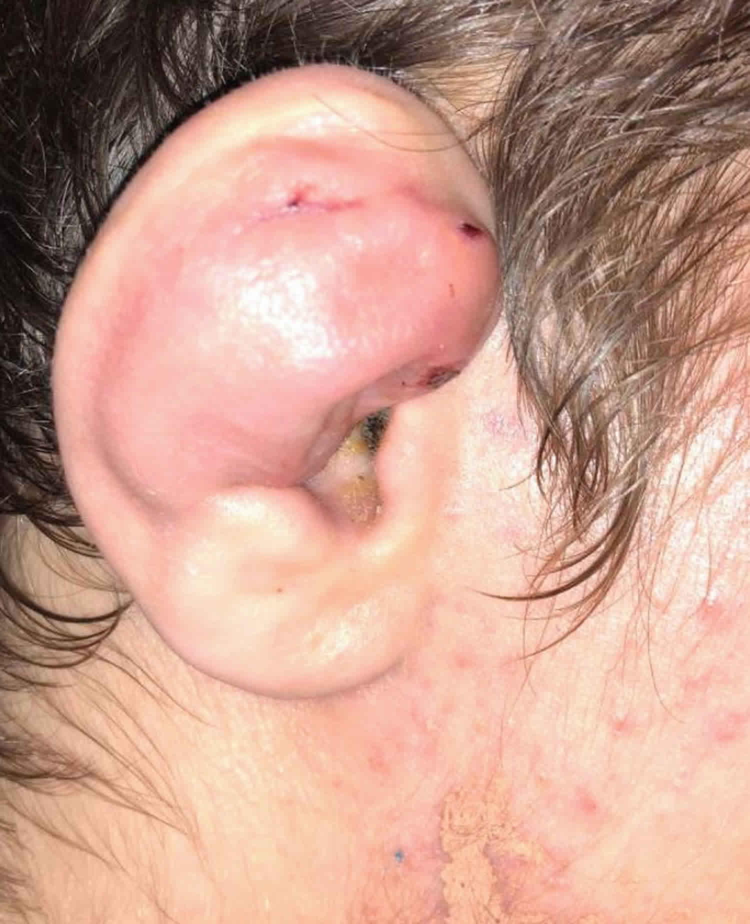 Detail Wrestling Cauliflower Ear Pictures Nomer 35