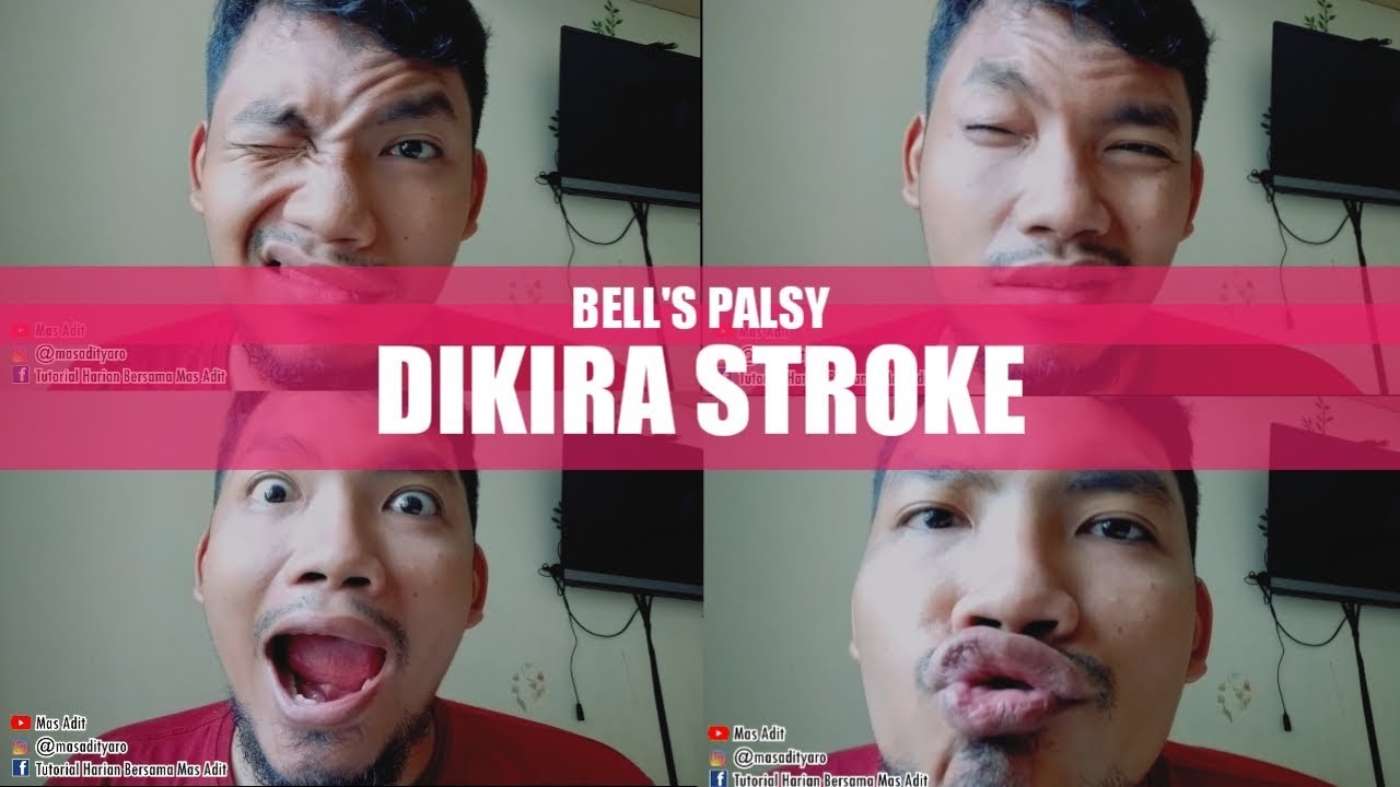 Detail Terapi Bells Palsy Di Rumah Nomer 15