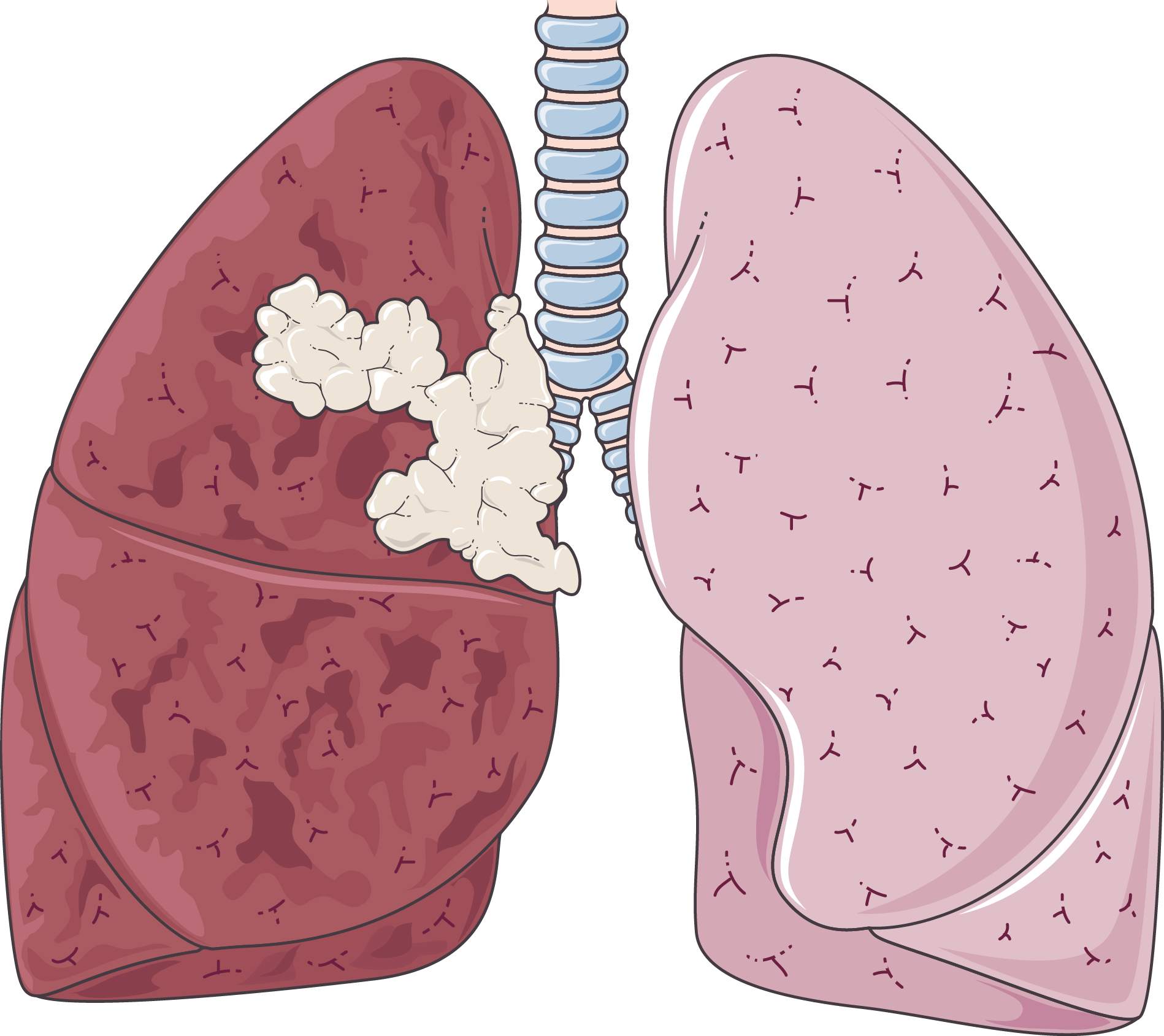 tumor-png-46-koleksi-gambar